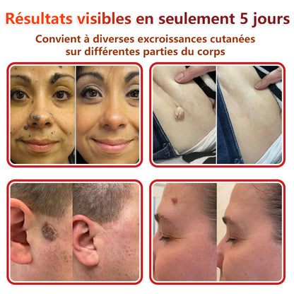 Patchs botaniques à micro-aiguilles Natravor® pour l'élimination des acrochordons ✅Fabriqué en France