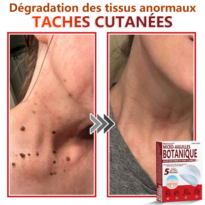 Patchs botaniques à micro-aiguilles Natravor® pour l'élimination des acrochordons ✅Fabriqué en France