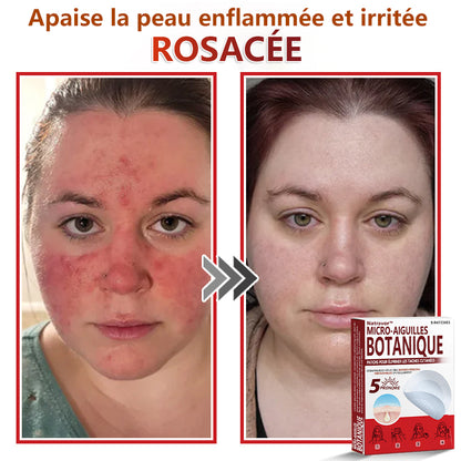 Patchs botaniques à micro-aiguilles Natravor® pour l'élimination des acrochordons ✅Fabriqué en France