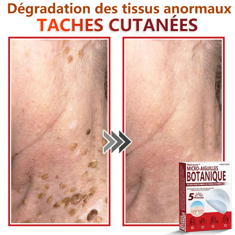 Patchs botaniques à micro-aiguilles Natravor® pour l'élimination des acrochordons ✅Fabriqué en France