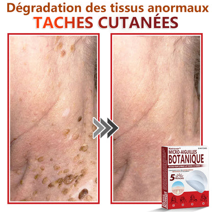 Patchs botaniques à micro-aiguilles Natravor® pour l'élimination des acrochordons ✅Fabriqué en France